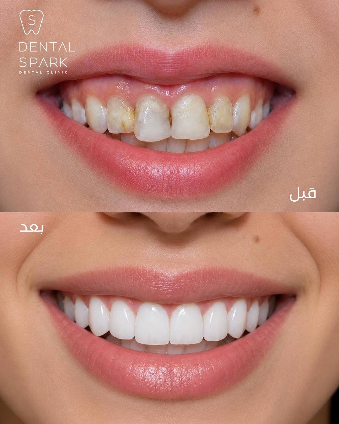 Before and After 1